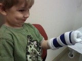UNC Hemiplegia Summer CIMT Camp